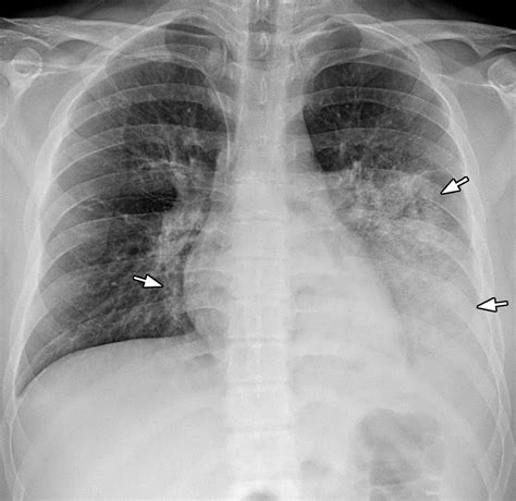 white spots on lungs pictures pneumonia